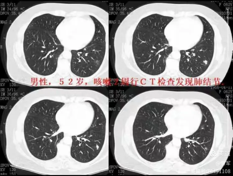 实性结节的病理影像思路
